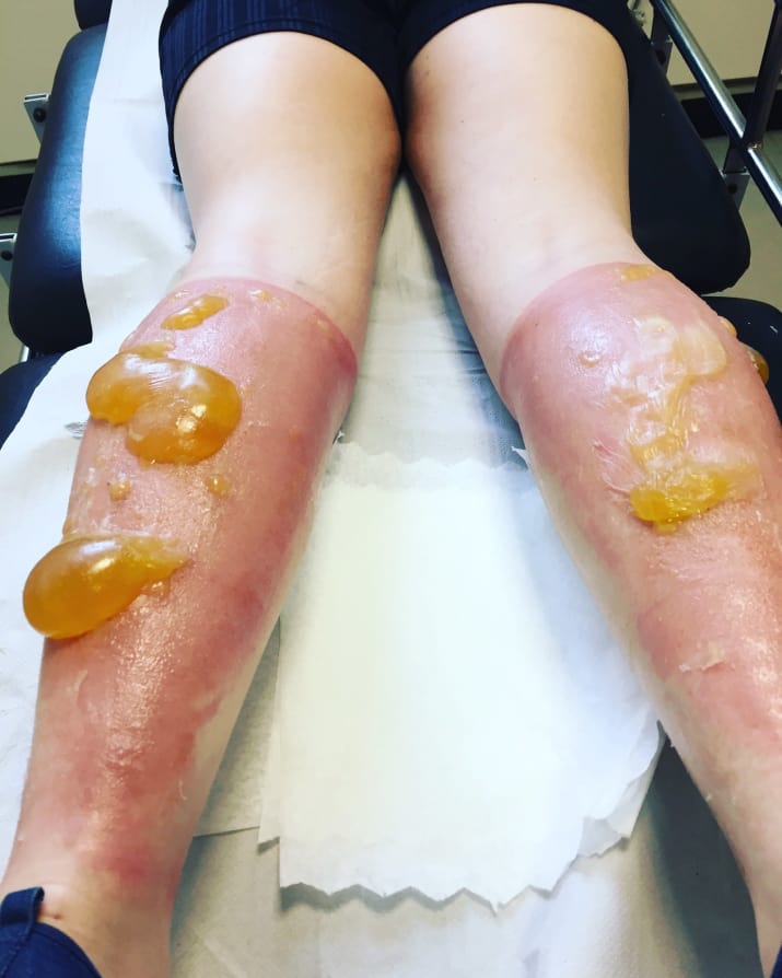 Ezek a brutális fotók mindig emlékeztetnek majd, hogy futás előtt használj naptejet