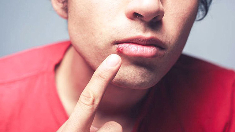 Így kerüljük el, hogy továbbfertőzzön az ajakherpesz