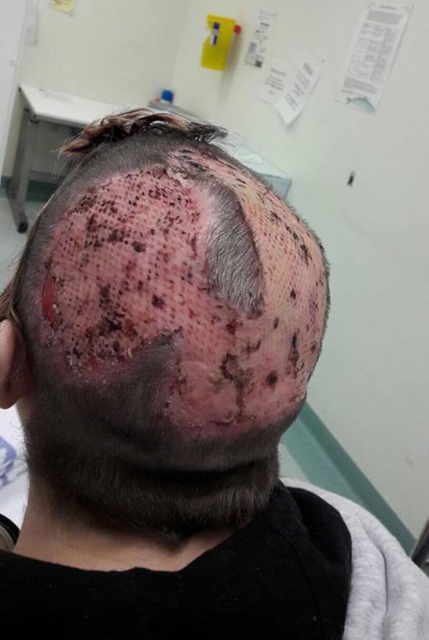 Unikornishajat akart, durva égési sérülés lett a vége