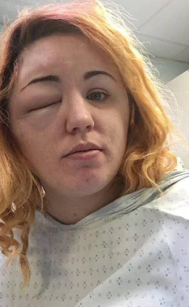 Unikornishajat akart, durva égési sérülés lett a vége