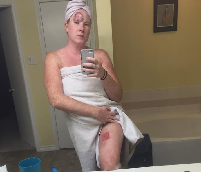 Döbbenetesen erős képekkel mutatja be egy anyuka, miért ne napozzunk naptej nélkül 