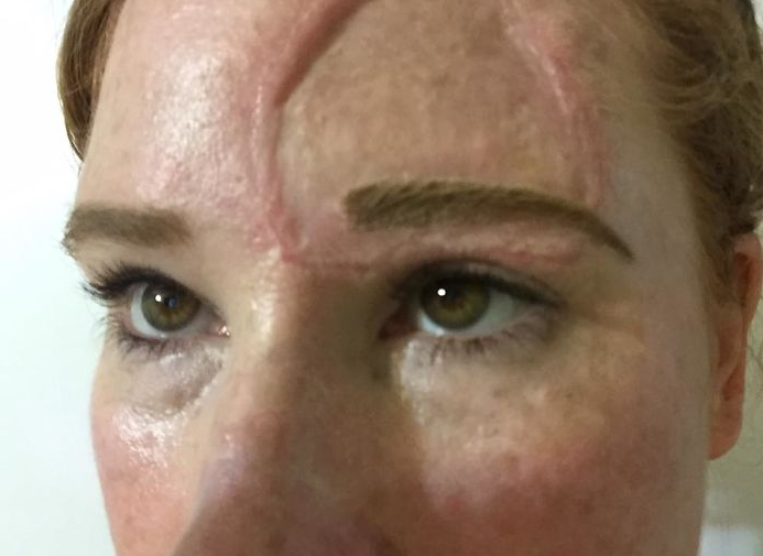 Döbbenetesen erős képekkel mutatja be egy anyuka, miért ne napozzunk naptej nélkül 