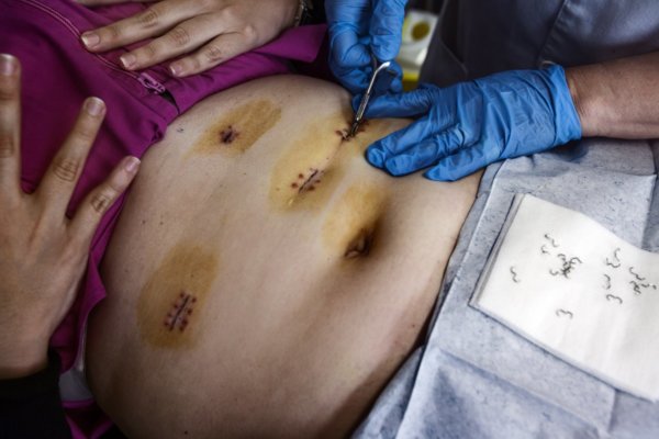 10 fotó a gyomorműtéttől az 50 kilós fogyásig 10 fotó a gyomorműtéttől az 50 kilós fogyásig