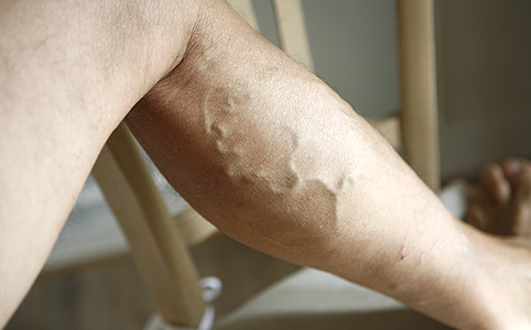 hogyan lehet dörzsölni a lábát visszérrel visszér kezelése hemofíliával