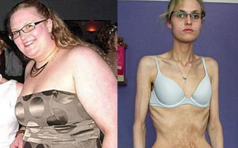 Az anorexia áldozatai-elrettentő fotók