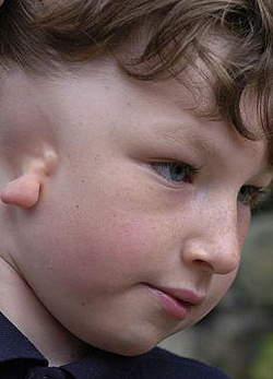 Ethannak Goldenhar-szindróma miatt nem fejlődött ki a füle 