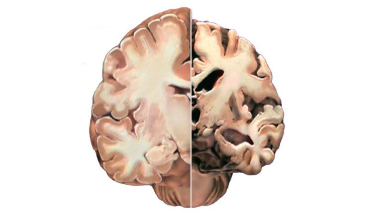 alzheimer kór agy demencia öregedés