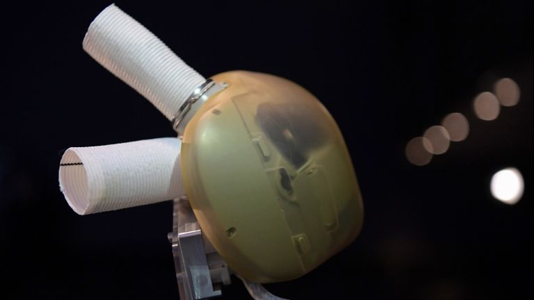 A Carmat-féle műszív (fotó: AFP / Christophe Archambault)