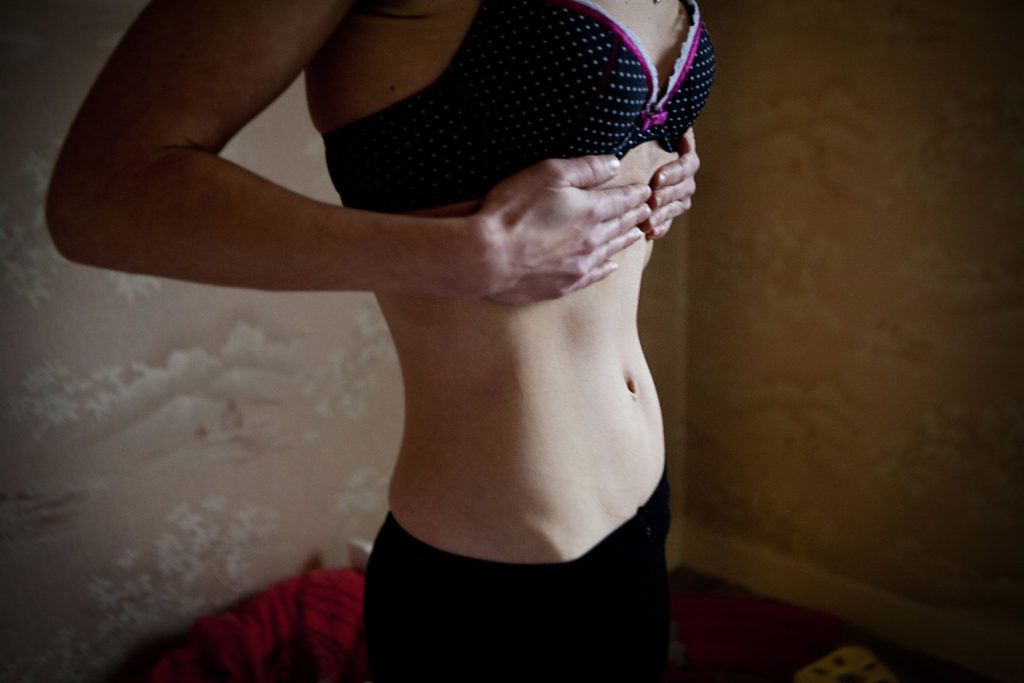 Anorexia evés zavar