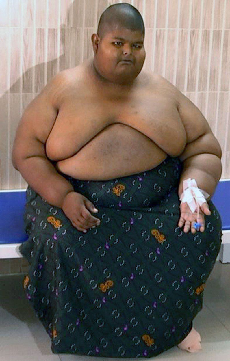 túlsúlyos kamasz india műtét