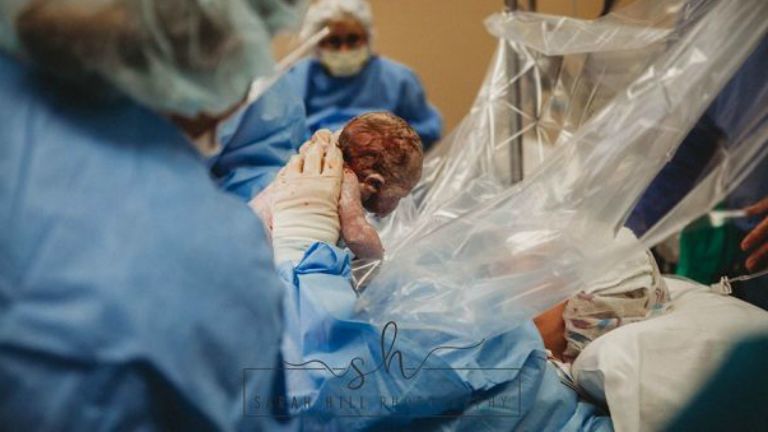 szülés császármetszés szülésznő