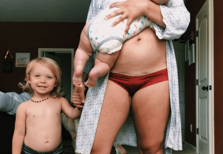 császármetszés fotó nyers őszinte bátor