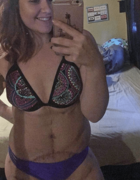 fogyás plasztikai műtét megnyúlt bőr önbizalom