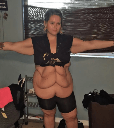 fogyás plasztikai műtét megnyúlt bőr önbizalom