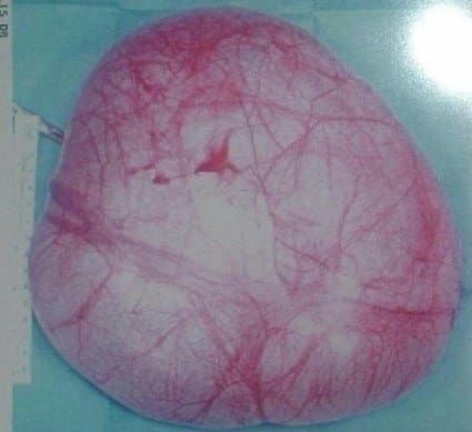 pcos policisztás ovárium tünetek betegség