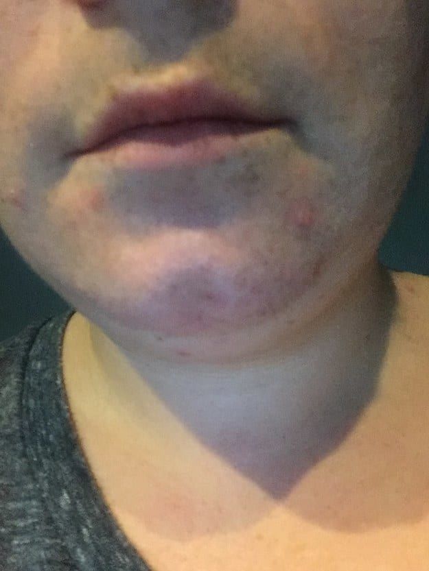 pco policisztás ovárium szindróma