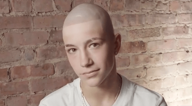 hajhullás alopécia önbizalom