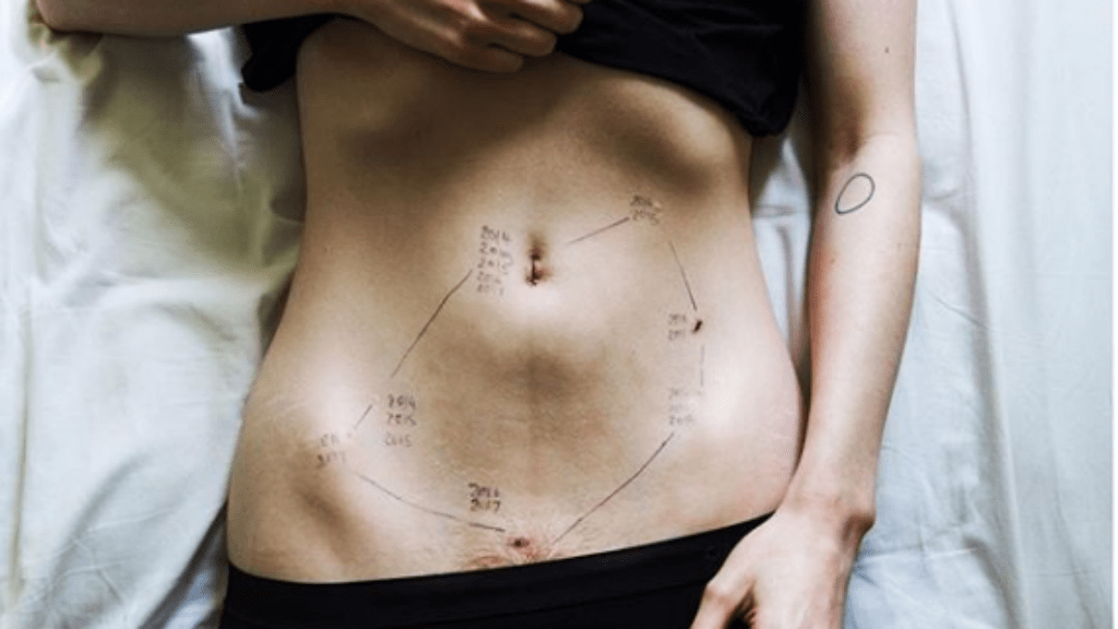 endometriózis kampány figyelemfelhívás