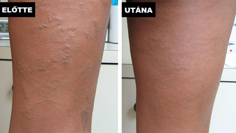 A magyar blogger lenyűgözte a világot visszérkezelési eredményeivel! (x)