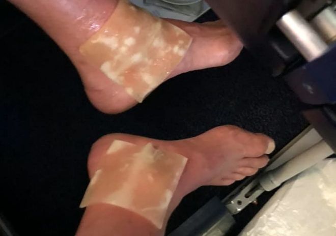 Thomas McNab égési sérülés ryanair