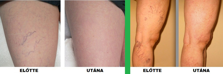 A magyar blogger lenyűgözte a világot visszérkezelési eredményeivel! (x)