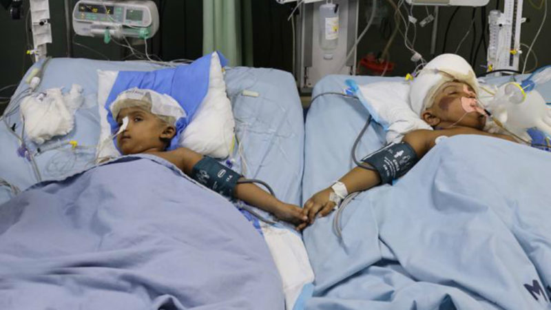 bangladesi sziámi ikrek