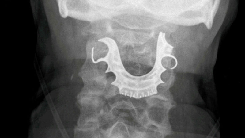 lenyelt protézis röntgen