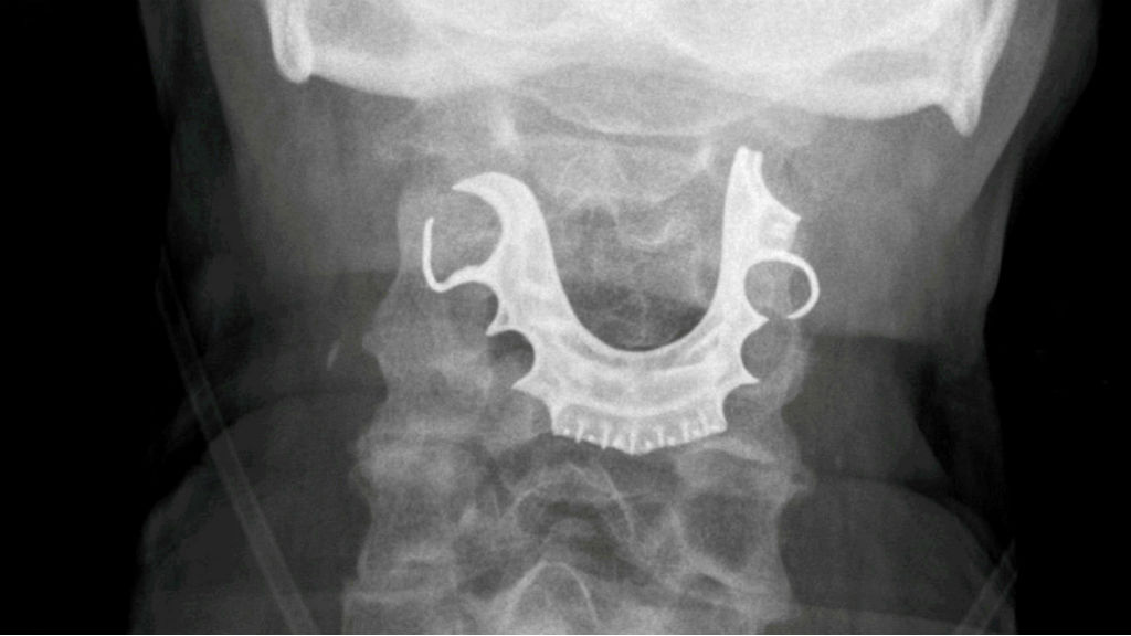 lenyelt protézis röntgen