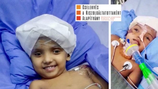 bangladesi sziámi ikrek rabeya rukaya