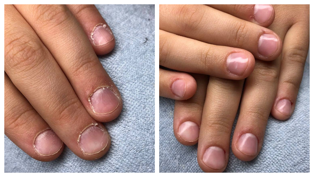 A lerágott körmöt is szépen rendbehozza a japán manikűr. (Fotó: Szendrényi Krisztina, Gel me up)