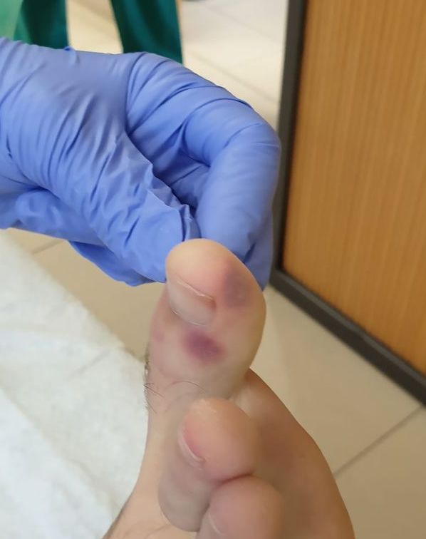 A lábunkon tűnhet fel a koronavírus első tüntete