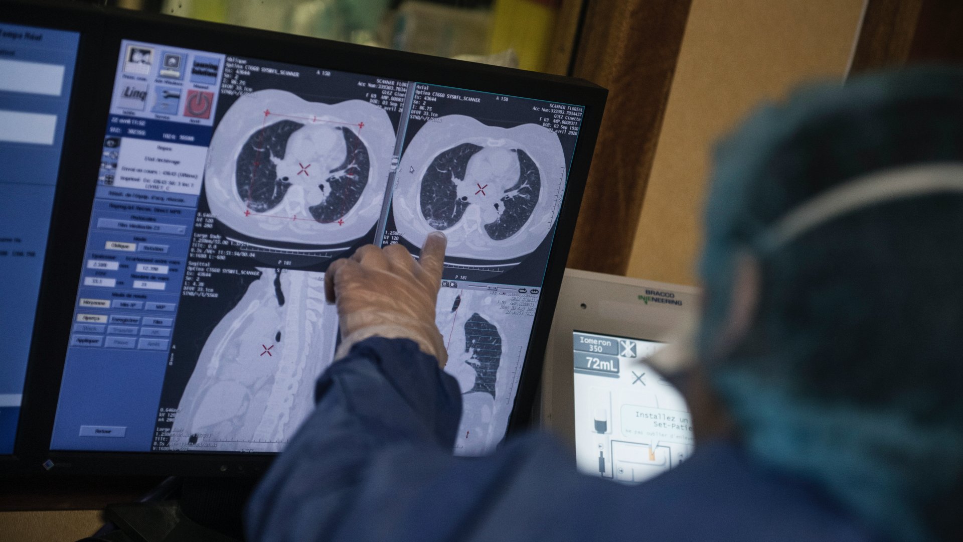 koronavírus röntgen