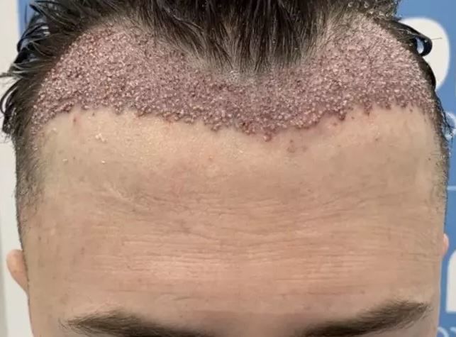 hajbeültetés beavatkozás hiba önbizalom