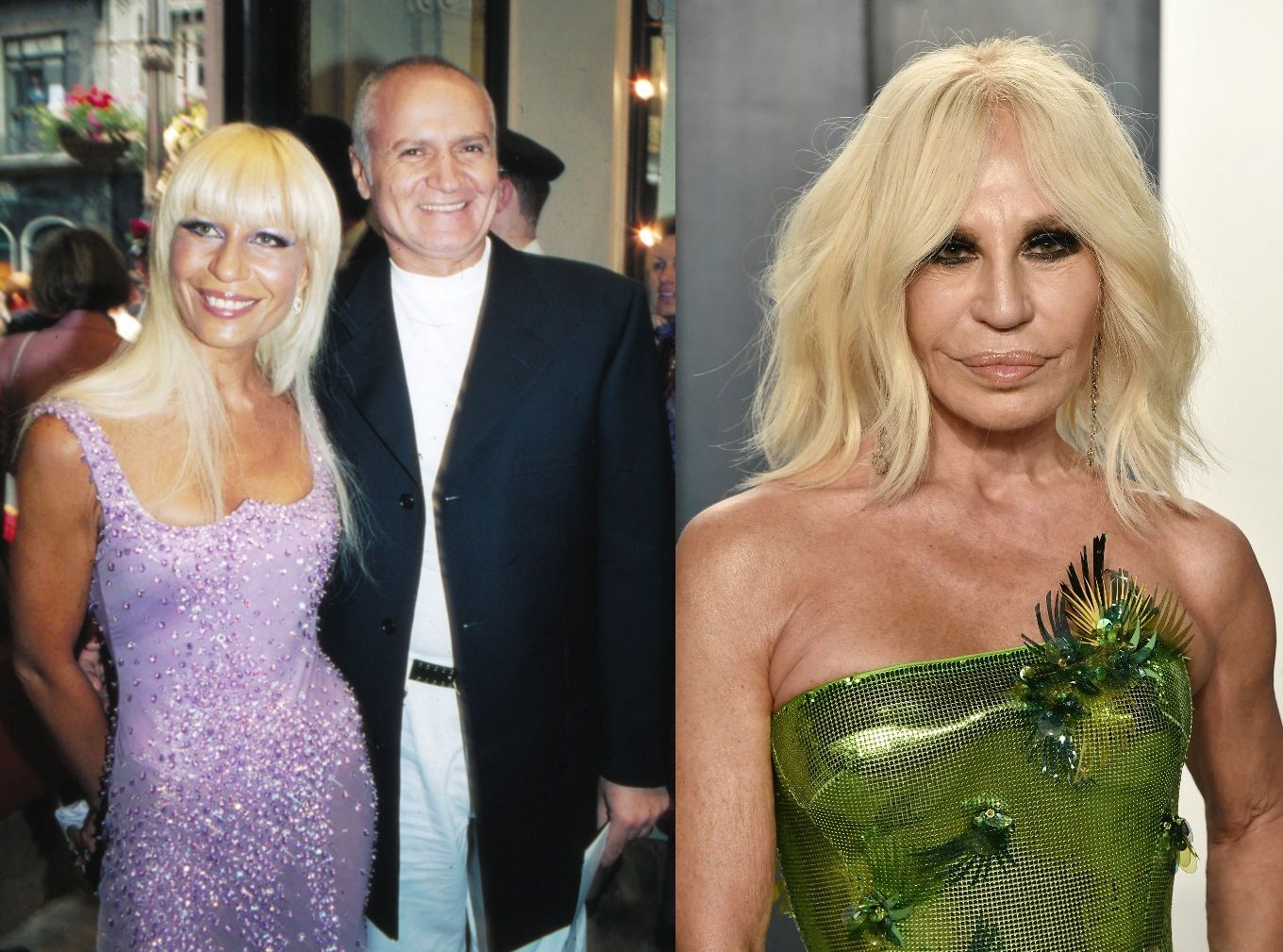 donatella versace plasztika előtt