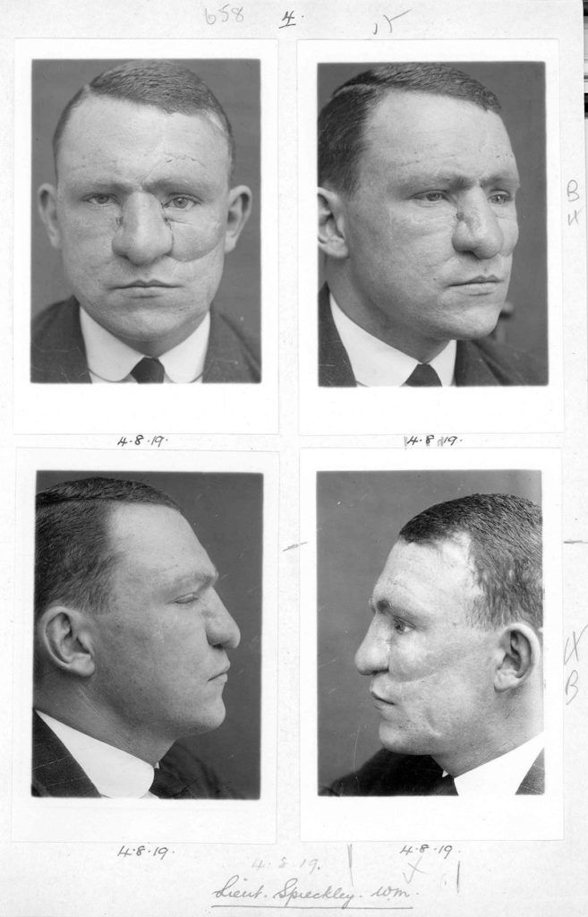 Az első arcplasztikát sebesült katonákon végezték el