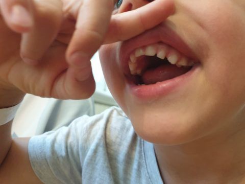 Nyitott harapású fogazatát mutatja a kisfiú