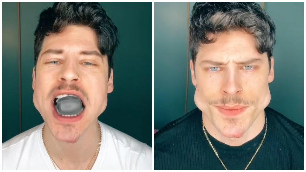 Eltorzult az arca az állkapocs-erősítéstől