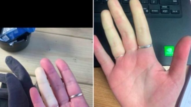 rendellenesség, kéz