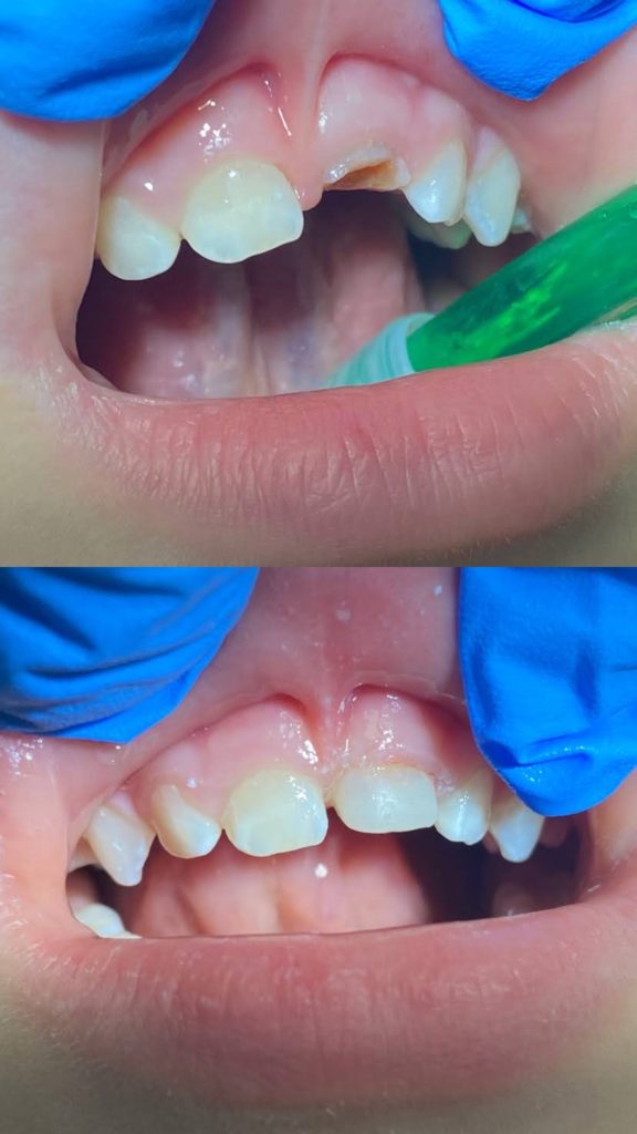 gyermekfogászat Szala Nóra fogorvos tejfog