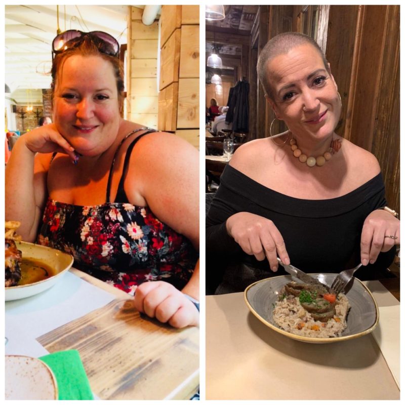 nagy fogyás gyomorszűkítő műtét óvónő