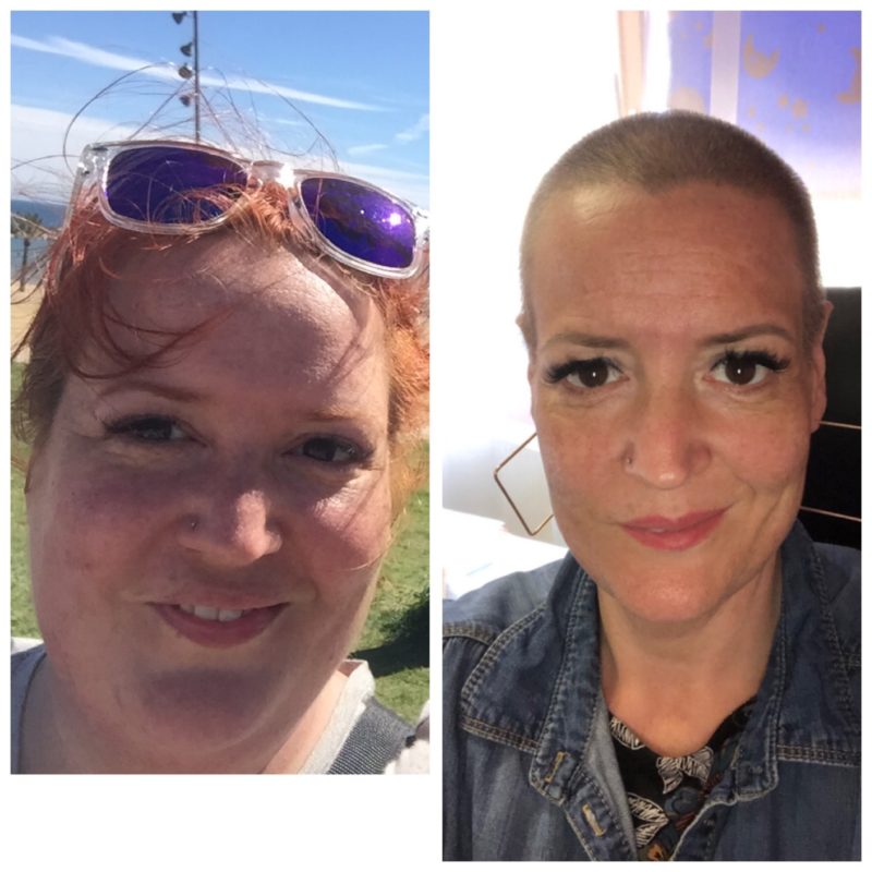 nagy fogyás gyomorszűkítő műtét óvónő