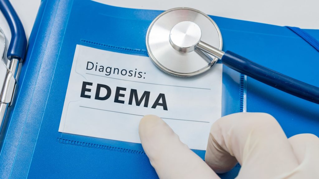Ödéma - nyirokdiagnózis a kék mappán sztetoszkóppal.