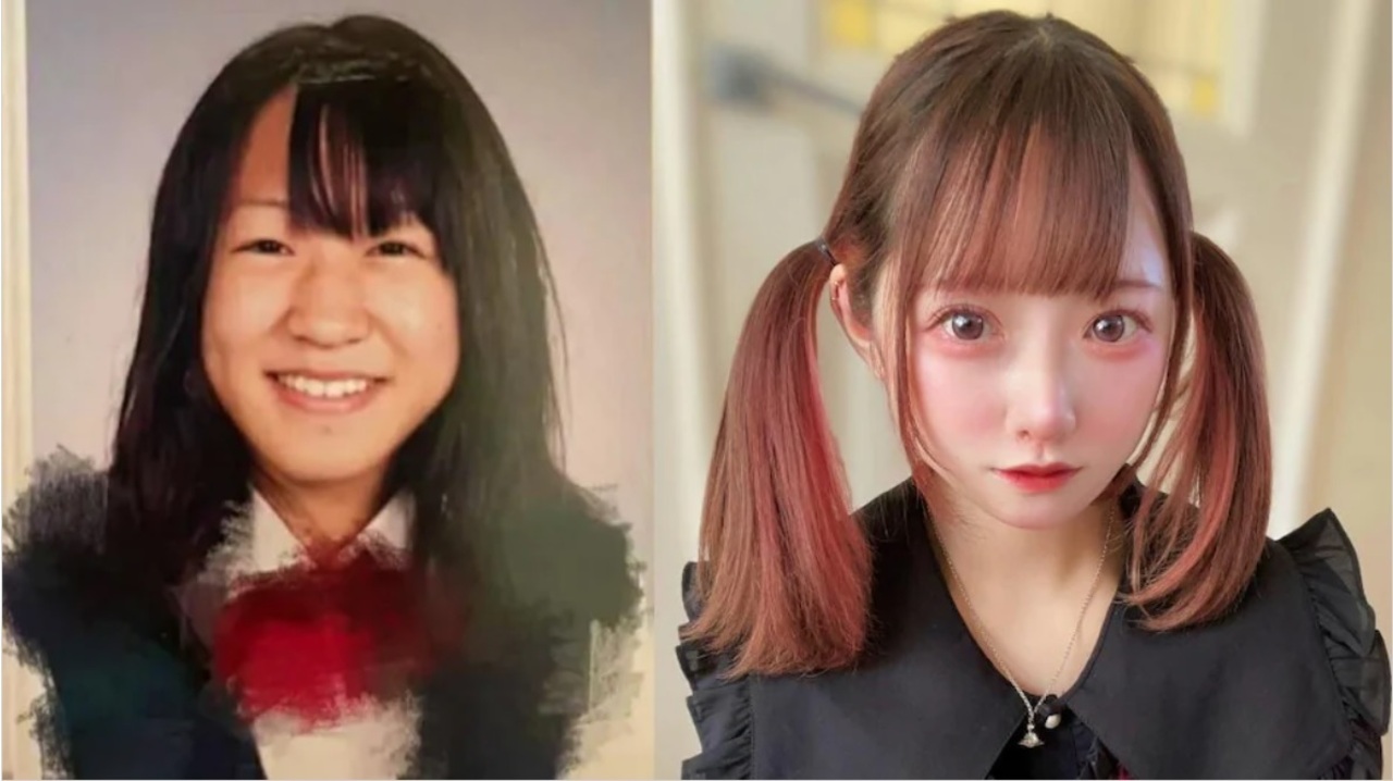 Zirazyo_ plasztikai sebészet előtt és után.