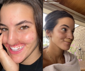 Kutyatamadasbol felepult lany