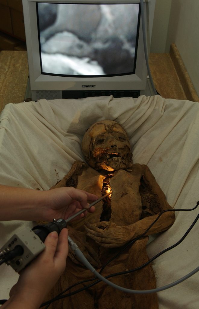 Laparoszkópos vizsgálatok egy múmián