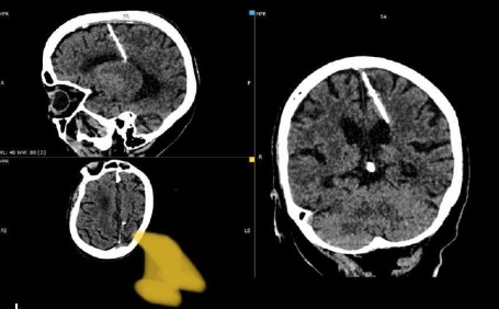 Tűt találtak egy idős orosz nő agyában, ami lehet, hogy születése óta ott volt - kép