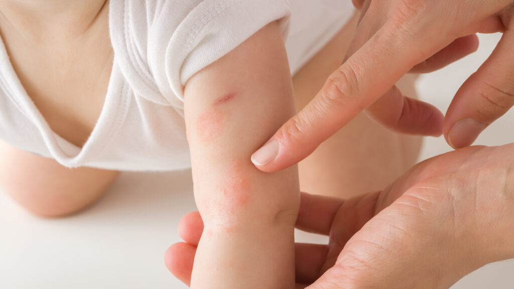 Kiütés tejallergiától