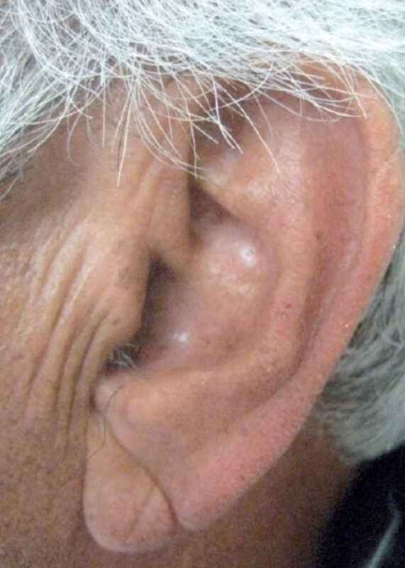 Frank-jel, forrás: stanfordmedicine25.stanford.edu