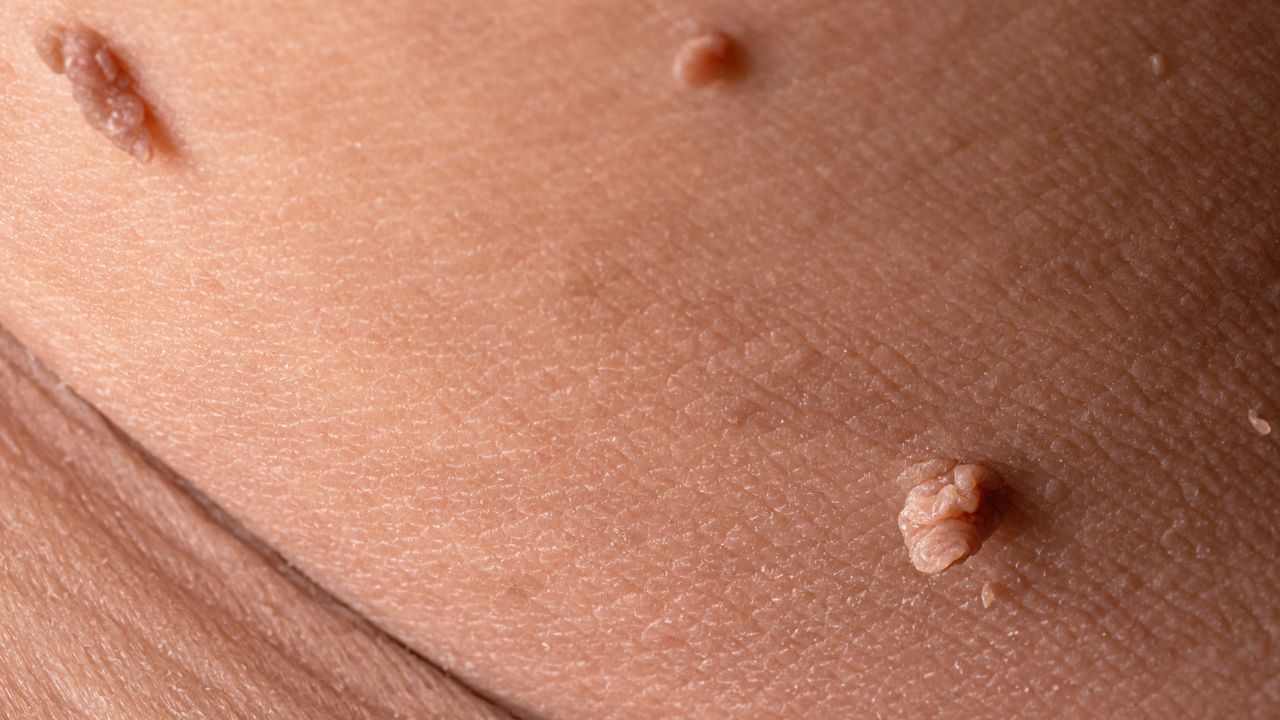 Fibrómák vannak a nyakadon? A tudósok felfedeztek egy aggasztó mintázatot