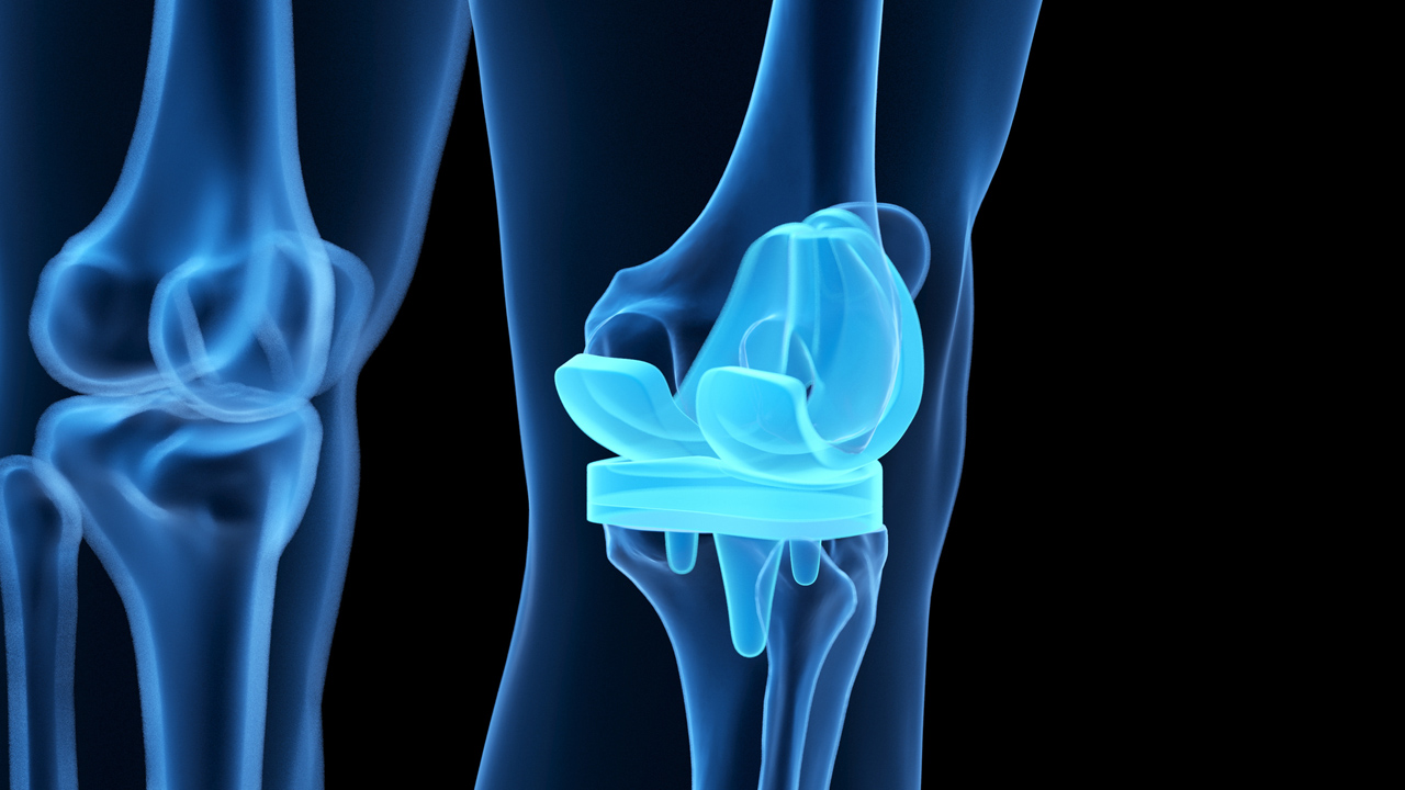 térdprotézis - fotó: Getty Images